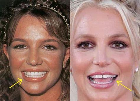 britney spears gap teeth|what happened to britney's teeth.